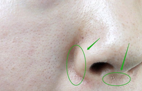 鼻子两侧的小疙瘩,下巴的白米粒是闭口 粉刺 还是毛周角化症