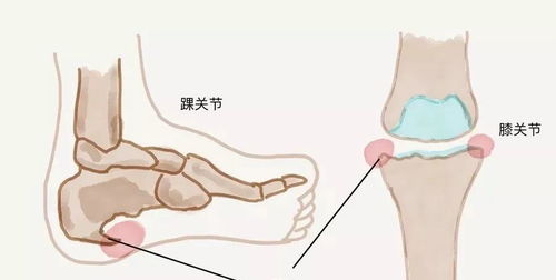 骨刺可以软化或溶解掉吗 骨刺可以用药物消除吗 健康百科