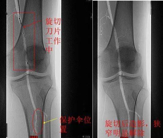 血管减容联合药涂球囊技术在下肢动脉硬化闭塞中的应用