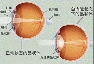 注意,手术才是治疗白内障的有效办法