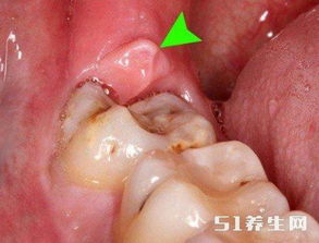 最里面的牙肉肿痛图片 信息图文欣赏 信息村 K0w0m Com