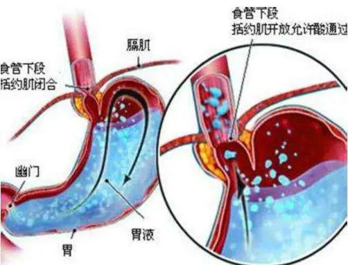 胃反酸 胃痛,反复不好,试试1种叶子,泡水喝好