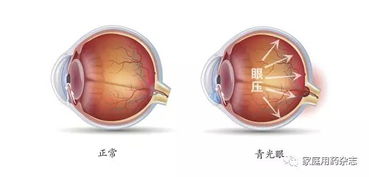 高危人群需警惕青光眼 