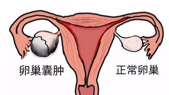 惊险！怀孕14周孕妇突发卵巢囊肿蒂扭转，危急时刻厚医妇科“扭转乾坤”