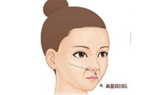 鼻底肌凹陷怎么弄好看 鼻翼基底凹陷怎么改善