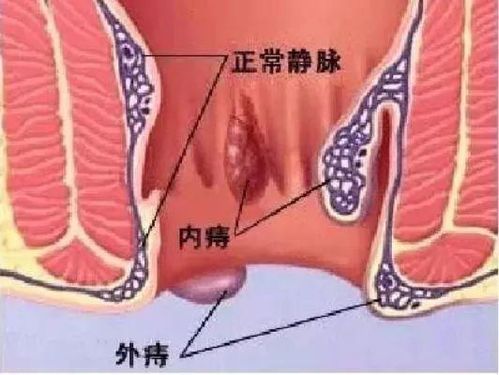 肛门疼痛是这些肛门疾病引起的