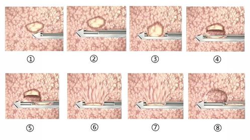 乳腺纤维瘤2厘米多能做微创手术吗