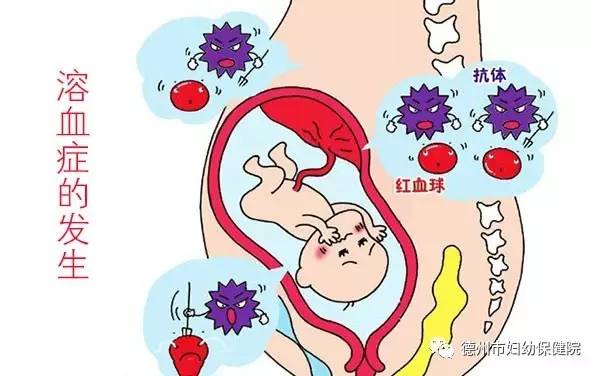 O型血女性 孕气 差 如何预防新生儿溶血 