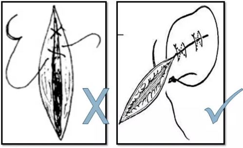 一文掌握急诊清创缝合技巧