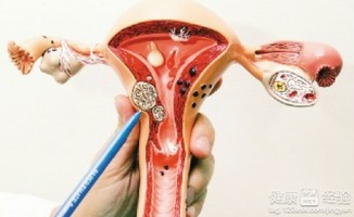 女性怎么样预防子宫肌瘤
