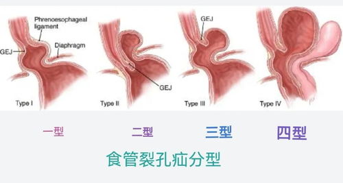 吉林到东莞,折磨60岁患者三年的顽疾在这里治愈