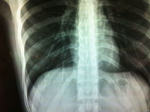 大家看看右下肺小结节影,这个情况严重吗