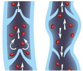静脉曲张患者该怎样护理治疗 用什么才能痊愈 