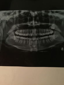 本人25要矫正牙齿 拍片子智齿是横着长得 还没长出来 医生说得拔掉 要不然矫正会把牙齿挤歪 我想问 