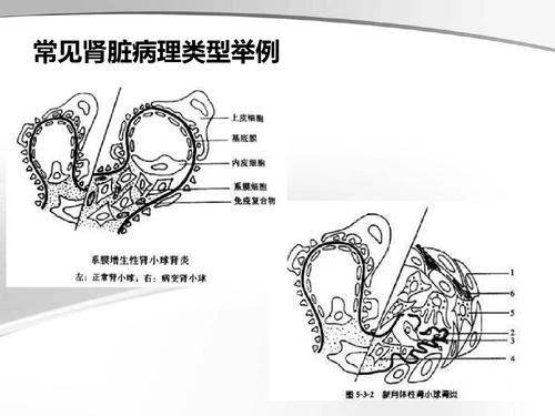 肾脏穿刺活检,真的那么可怕吗