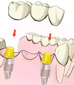 种植牙太贵了,怎么做才能省点钱