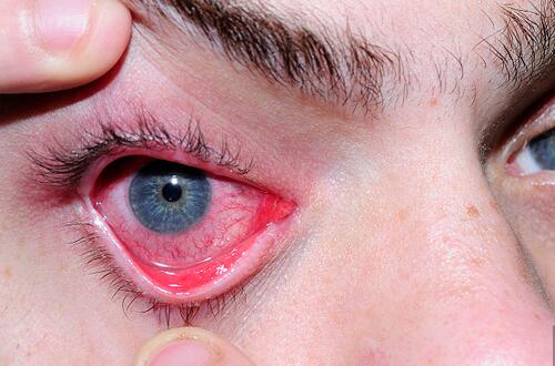 红眼病几天能好 越早治疗越快好 
