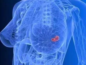 男性会的乳腺癌吗 带你了解男性乳腺癌的早期症状