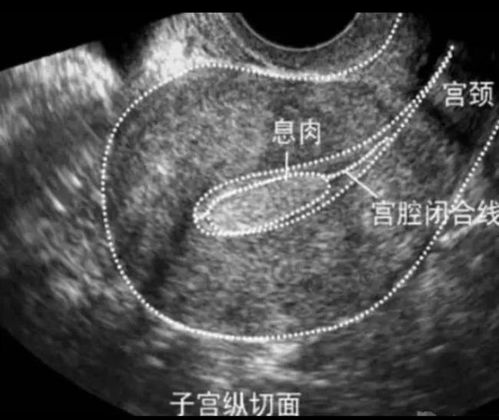 宫腔镜手术（去除子宫内膜息肉和部分性纵隔）后当月来月经特别多是什么原因？