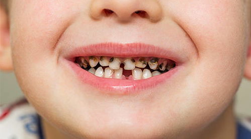 4岁娃牙齿几乎全黑 罪魁祸首不是糖而是......