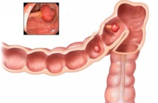 中医能治结肠息肉吗(中医治疗结肠息肉最好的医院)