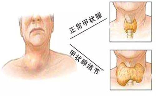 甲状腺长了结节应该怎么办呢 要不要切除掉 代文新专家 先判断性质