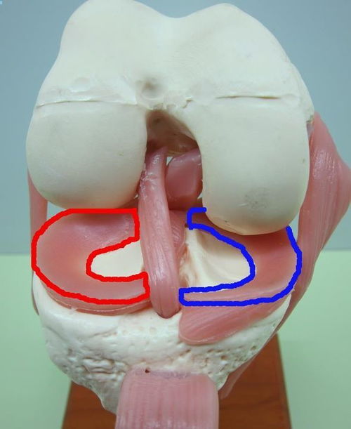 半月板二度损伤图片图片