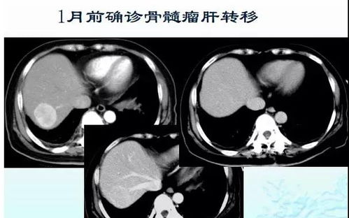 造影剂会过敏 增强CT没有必要做 医生总结了5点实用化建议