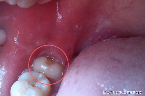 原来智齿长不好会引起 冠周炎 急性发作期为什么不能拔除吗