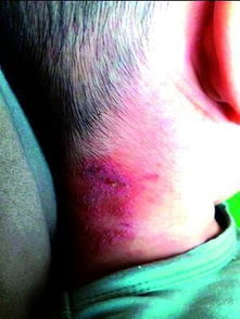 小心 鹤壁女子拍死儿子脖子上的一只虫,结果却导致皮肤溃烂 