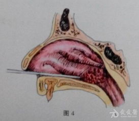 耳鼻咽喉头颈外科手术征集 下鼻甲部分切除术