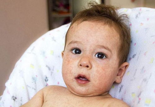宝宝湿疹吃什么奶粉 婴儿湿疹吃什么奶粉