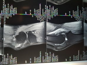 万能的百度,有会看核磁共振的吗 请帮我看看这个膝盖片子 