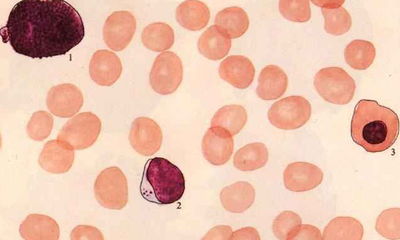 血小板白细胞及红细胞降低