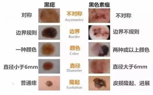 SIS基底膜胶原对面部色素痣电灼术后的治疗效果