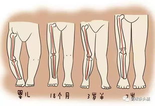 关注孩子腿型发育,宝宝的青蛙腿需要及时纠正吗 