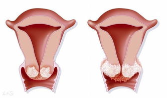 宫颈癌白带有什么症状 