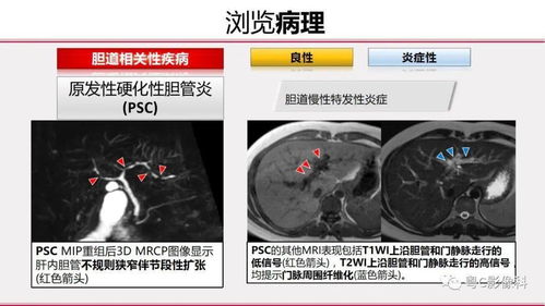 磁共振胰胆管成像 MRCP 放射科医生必须知道的专业知识