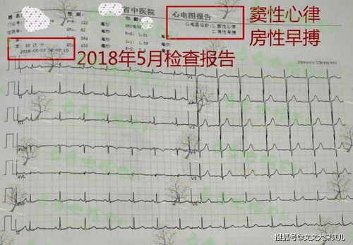 心电图检查出窦性心律，频发室性早搏，请问可以做流产吗(频发室性早搏,窦性心动过速)