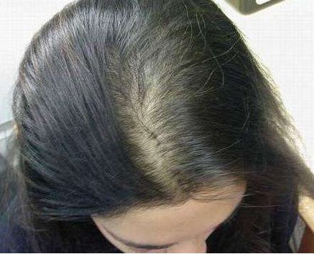 女生脱发严重的原因有哪几种 女生掉头发吃什么好呢