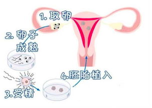 难孕多囊卵巢排卵障碍适合做试管助孕吗？能怀宝宝吗？