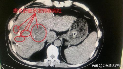 结肠癌肝肺转移病例,不手术治疗诊治过程分享