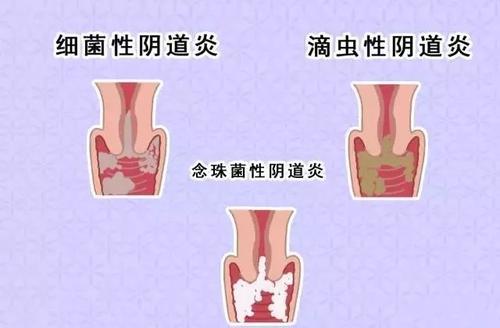 滴虫性阴炎哪些症状 