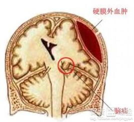 硬膜外麻醉两年多后背针眼还疼怎么办