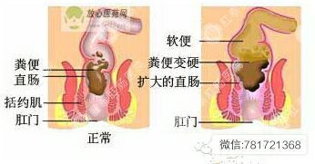 便秘怎么办 便秘治疗方法 