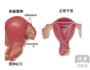 卵巢囊肿剔除术多少钱 不治疗是具有危害性的