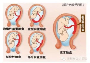 产妇胎盘前置,非常凶险,幸亏有这群人守护