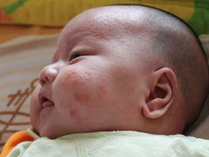 新生儿脸上长红点，婴儿脸上长红疹子是怎么回事