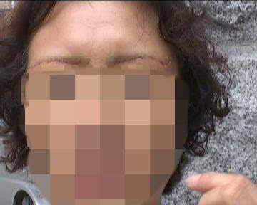 长春女子为变美做了切眉 术后发现俩眉毛不一样