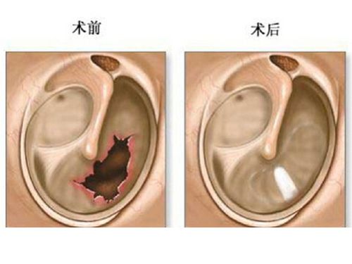 贵阳铭仁耳鼻喉医院 7岁孩子打翻电饭锅,爸爸一耳光竟导致孩子耳膜穿孔